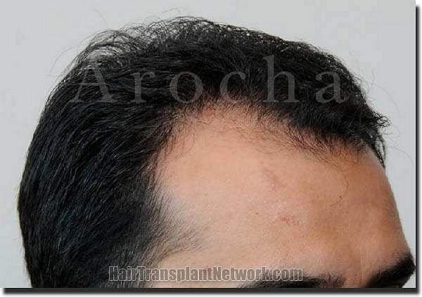 Hair restoration procedure results