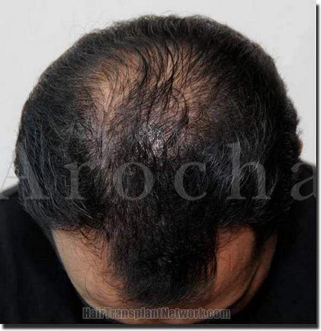 Hair restoration procedure results