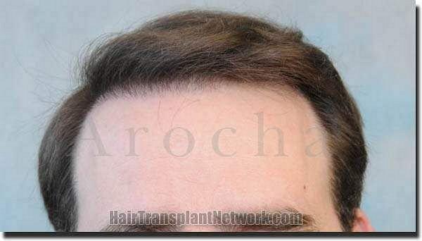 Hair restoration procedure results