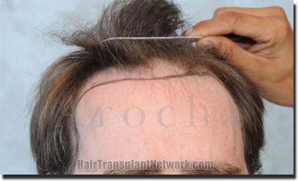 Hair restoration procedure results