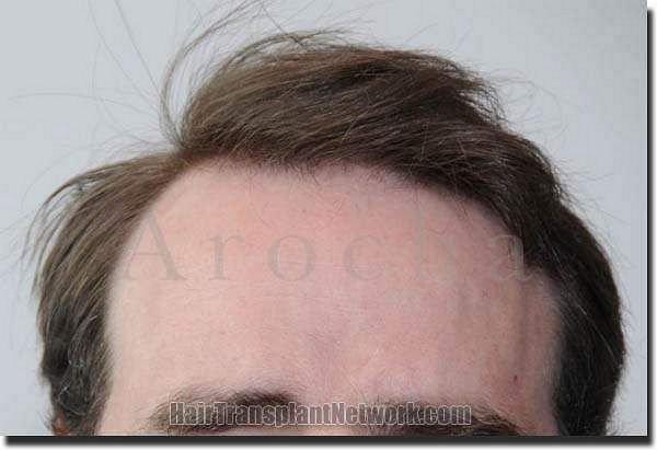 Hair restoration procedure results