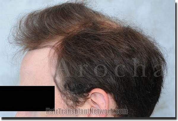 Hair restoration procedure results