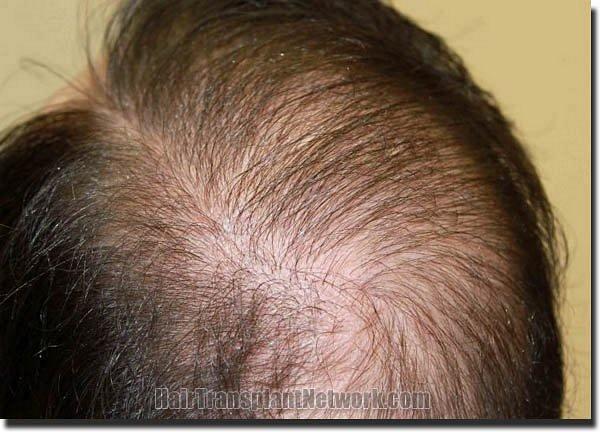 Hair restoration procedure results