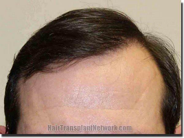 Hair restoration procedure results