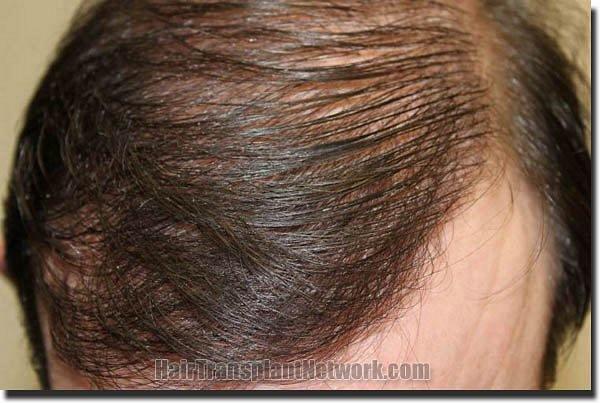 Hair restoration procedure results