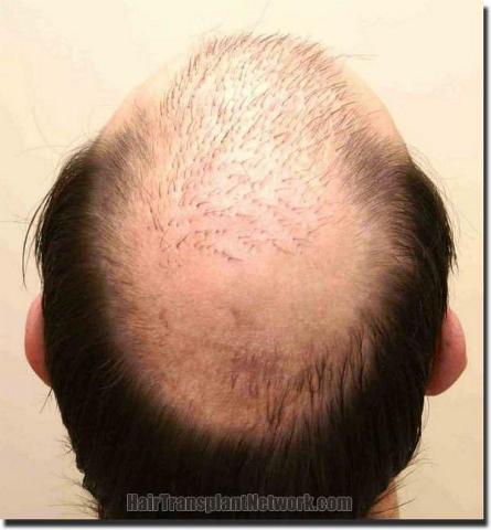 Hair restoration procedure results