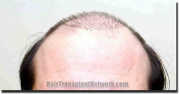 Hair restoration procedure results