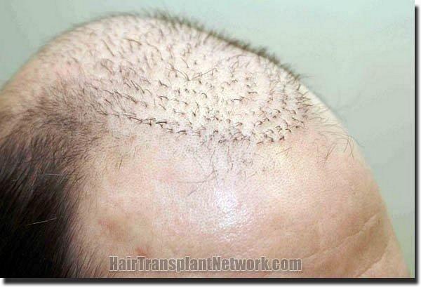 Hair restoration procedure results