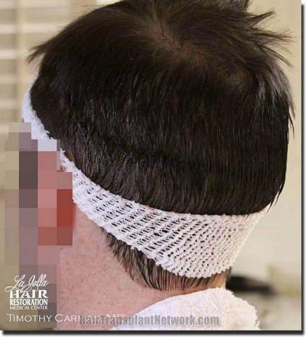 Hair restoration procedure results