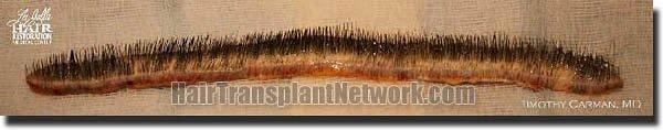 Hair restoration procedure results