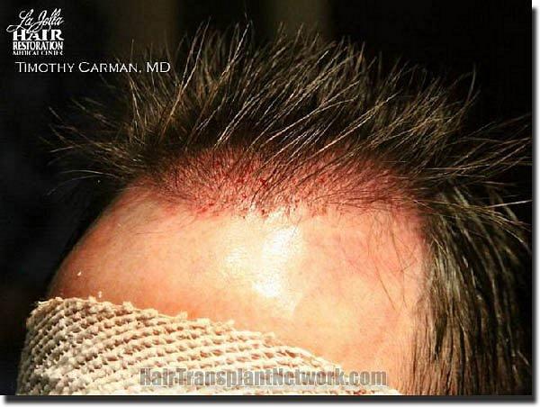 Hair restoration procedure results