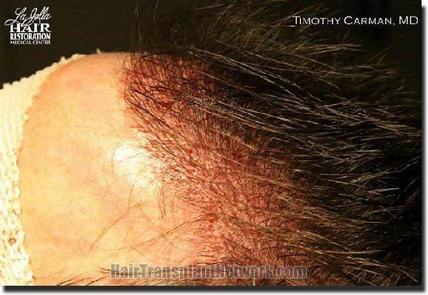 Hair restoration procedure results