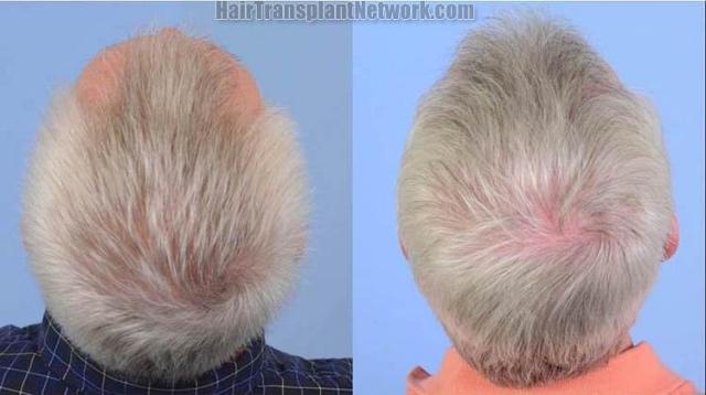 Hair replacement surgery before and after images