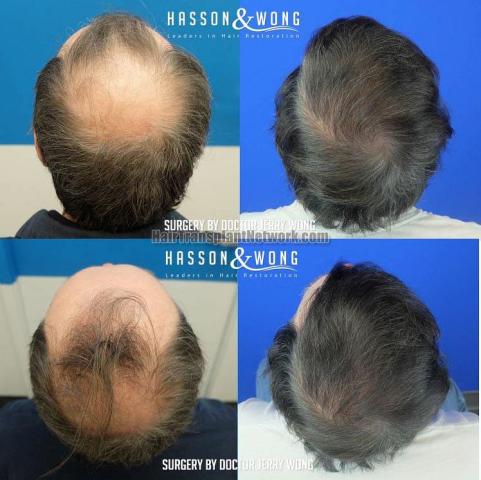 Surgical hair transplantation result photographs