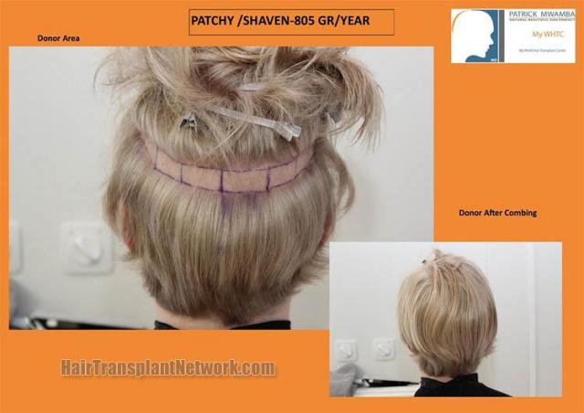 Hair transplantation surgery before and after pictures