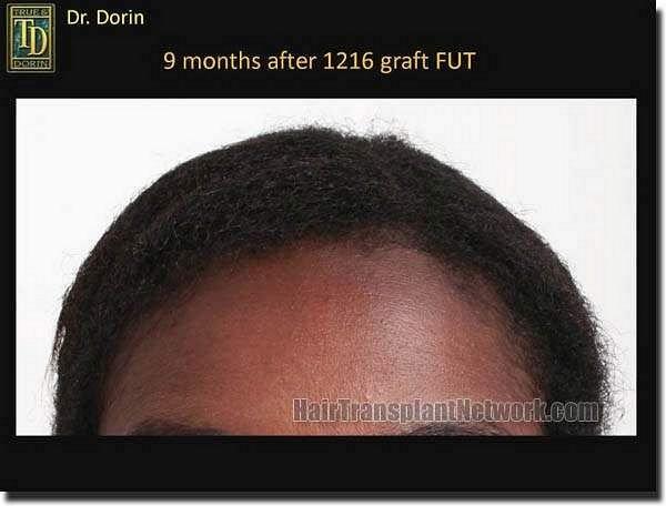 Hair restoration procedure results