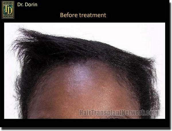 Hair restoration procedure results