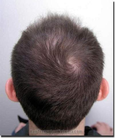 Hair restoration procedure results