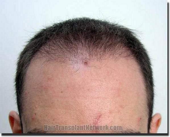 Hair restoration procedure results