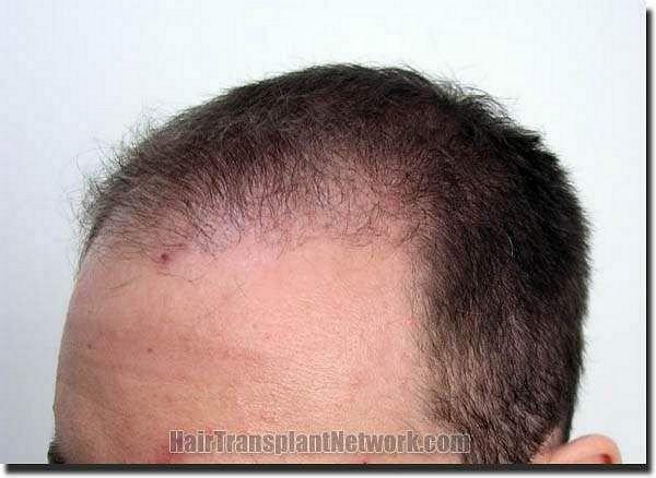 Hair restoration procedure results