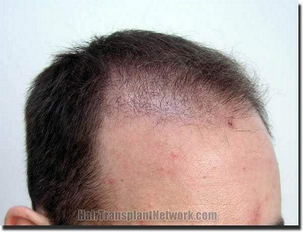 Hair restoration procedure results