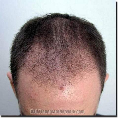 Hair restoration procedure results