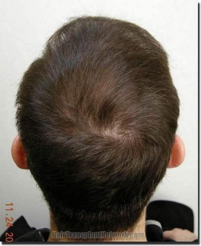 Hair restoration procedure results