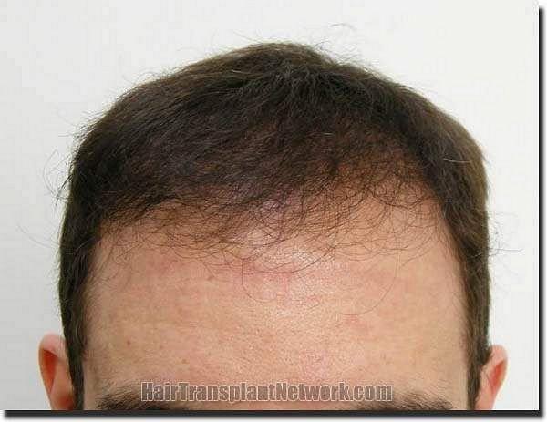 Hair restoration procedure results