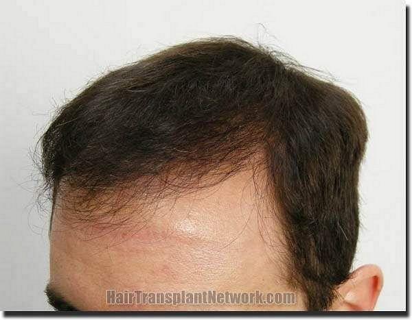 Hair restoration procedure results