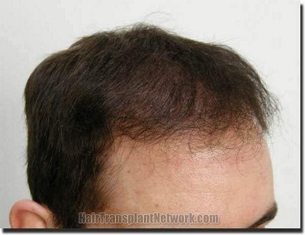 Hair restoration procedure results