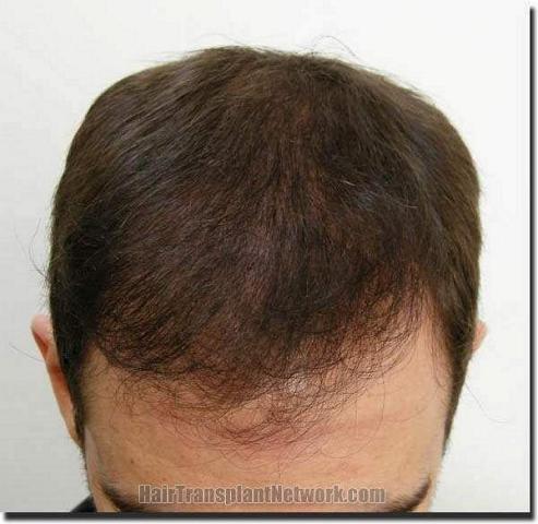 Hair restoration procedure results