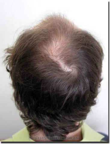 Hair restoration procedure results