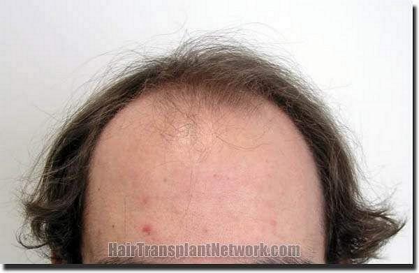 Hair restoration procedure results