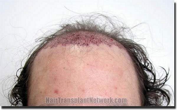 Hair restoration procedure results