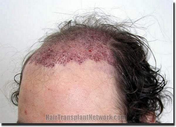 Hair restoration procedure results