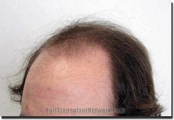 Hair restoration procedure results