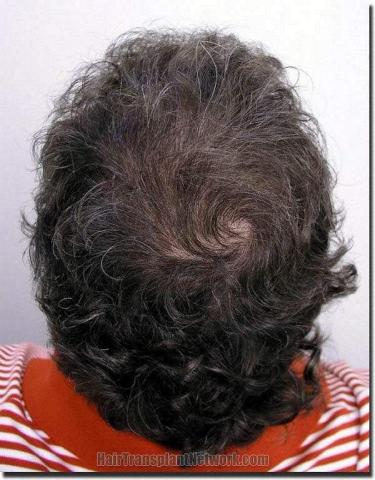 Hair restoration procedure results