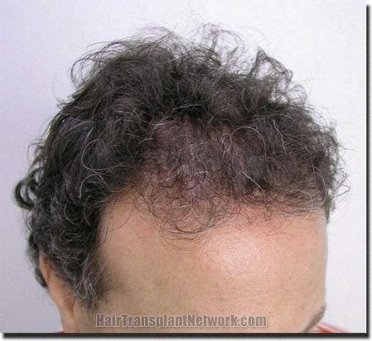 Hair restoration procedure results