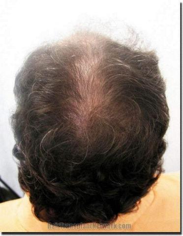 Hair restoration procedure results