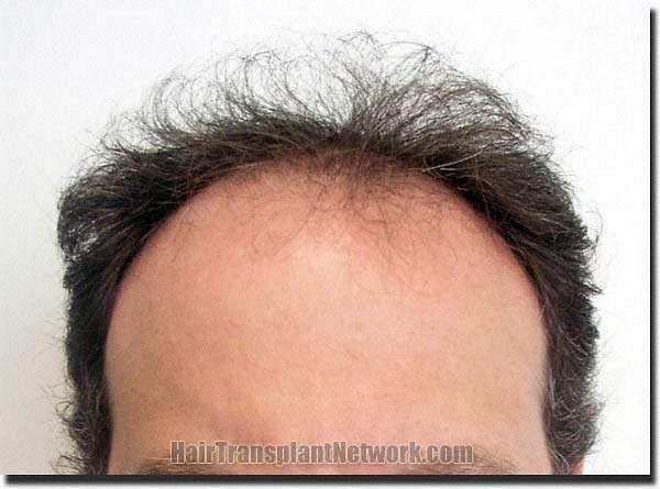 Hair restoration procedure results