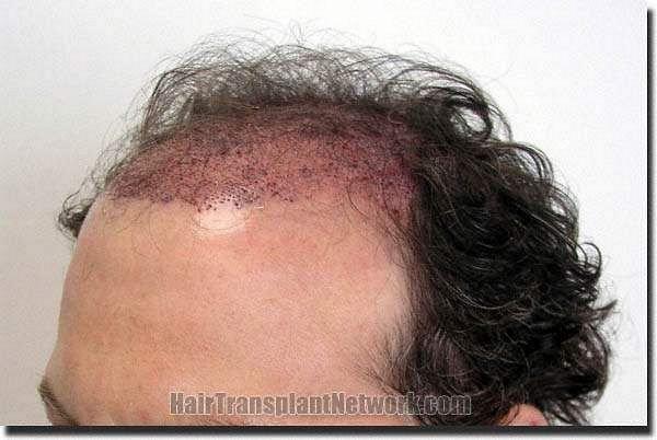 Hair restoration procedure results