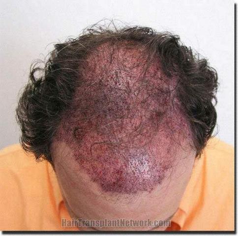 Hair restoration procedure results