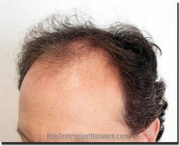 Hair restoration procedure results