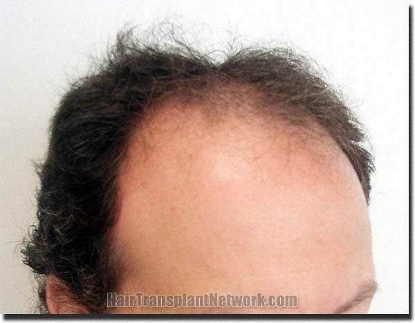 Hair restoration procedure results