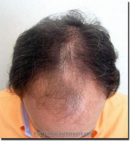 Hair restoration procedure results