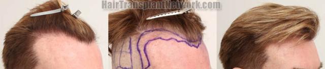 Hair transplantation procedure before and after results