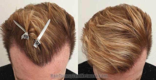 Before and after hair restoration procedure images