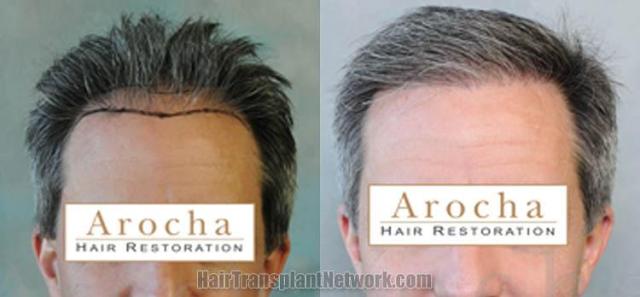 Hair restoration procedure before and after results