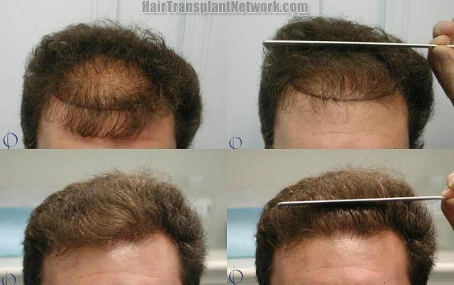 Hair restoration procedure before and after pictures