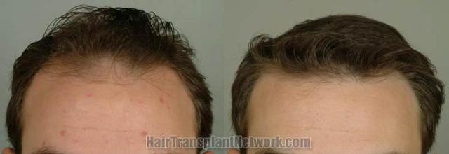 Hair restoration procedure before and after results